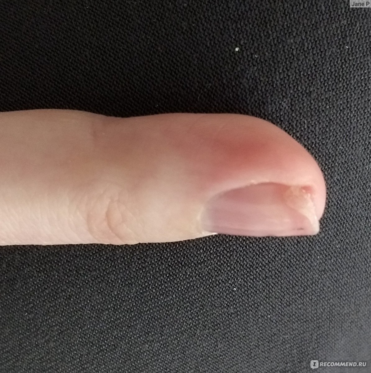 Вид сбоку, где повреждения. Средний палец