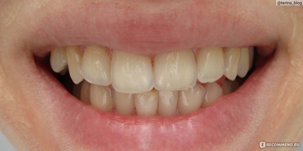 Зубы после 2-х недель использования SPLAT, после чистки, меня такая "чистота" абсолютно не устраивает!