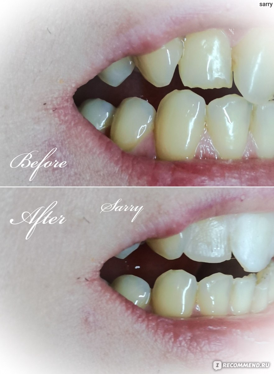 Виниры Aliexpress set for whitening teeth and upper and lower veneers фото