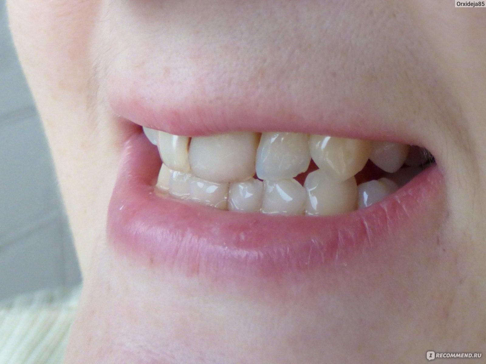 Спустя 1,5 месяца чистки зубной пастой Сплат Ультракомплекс