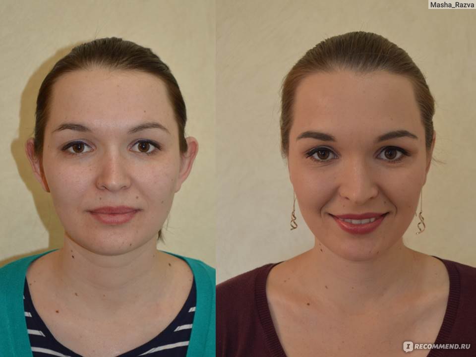 отопластика максим осин. отопластика до и после. отопластика до и после фото. отопластика до и после. операция на уши от лопоухости.