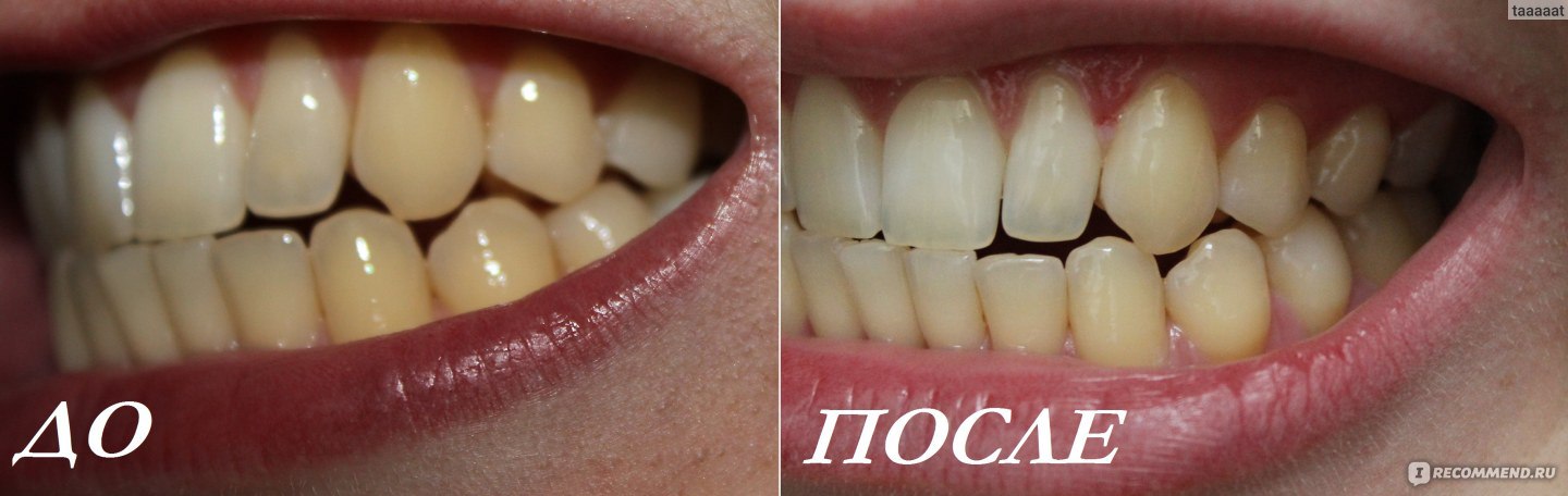 Результат использования Зубной пасты SPLAT Отбеливание плюс