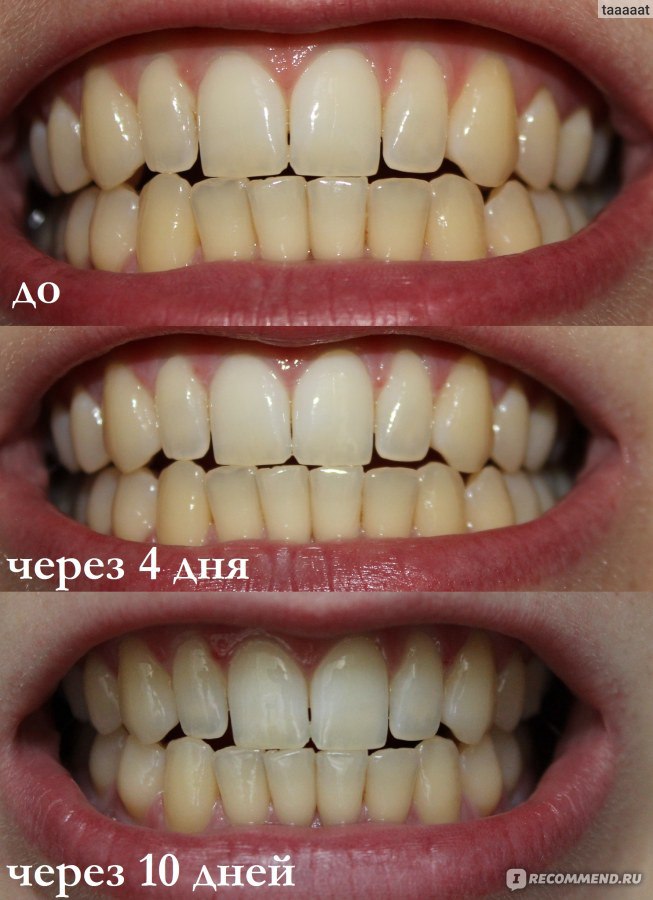 Результат использования Зубной пасты SPLAT Отбеливание плюс